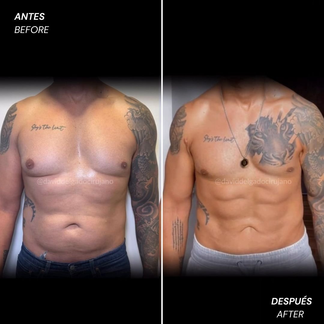 Abdominal etching before and after result in Colombia with Dr. David Delgado