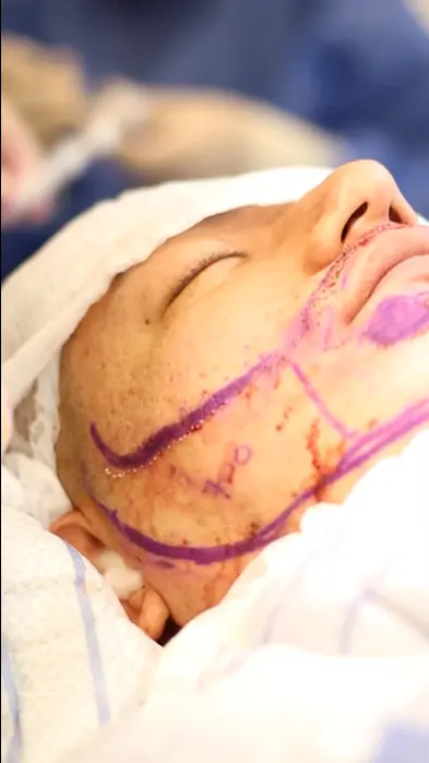 Beard Transplant in Colombia- Plastic Surgery Medellín