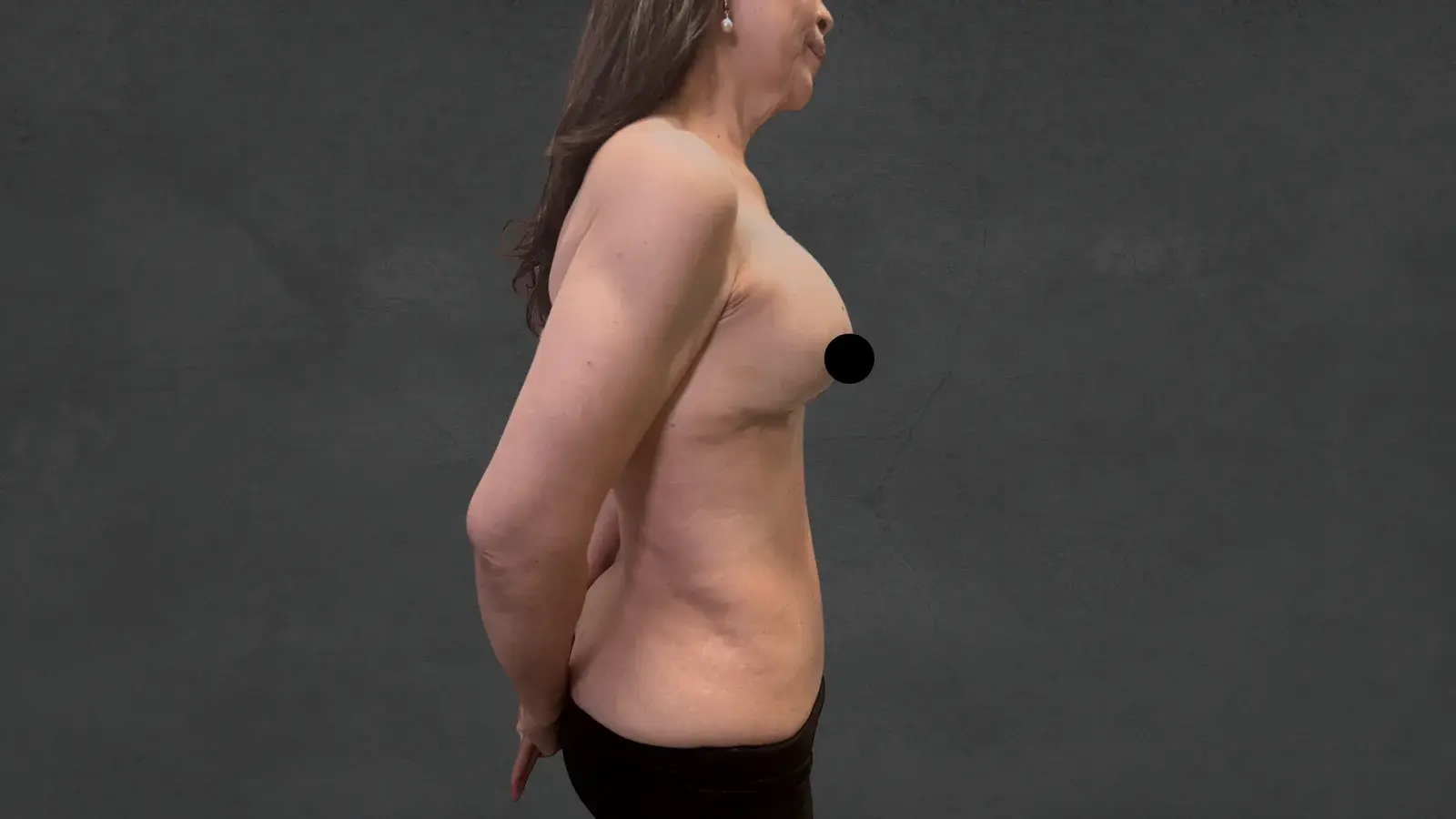 Plastic Surgery in Colombia- Plastic Surgery Medellín