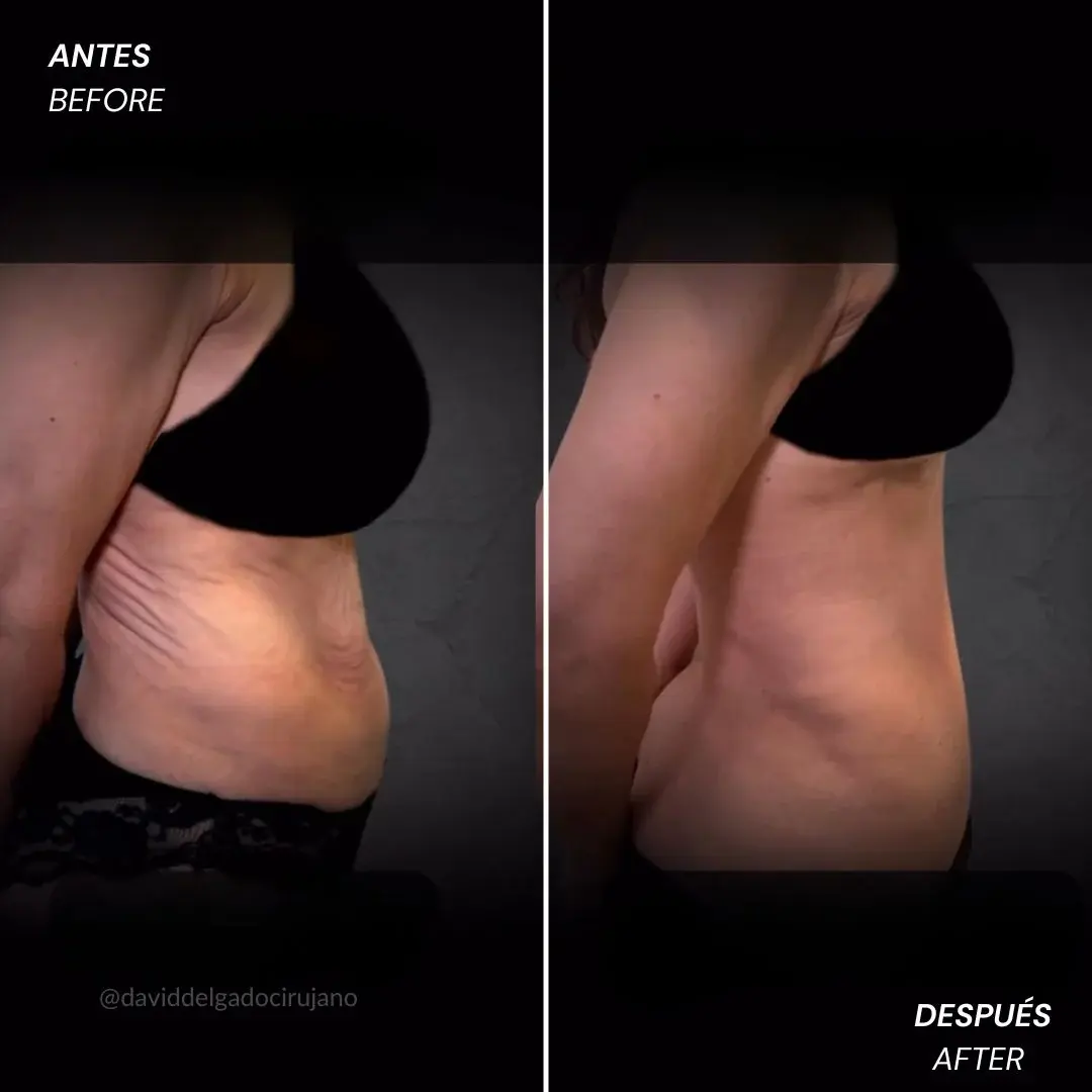 Plastic Surgery in Colombia- Plastic Surgery Medellín