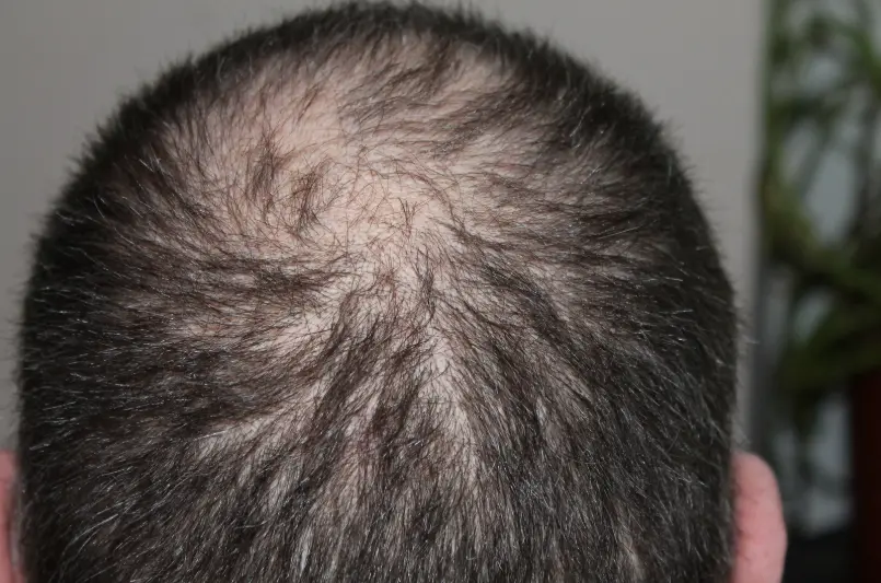 Hair transplant cost Colombia- Dr. David Delgado- Dharma Hair in Medellín, Colombia