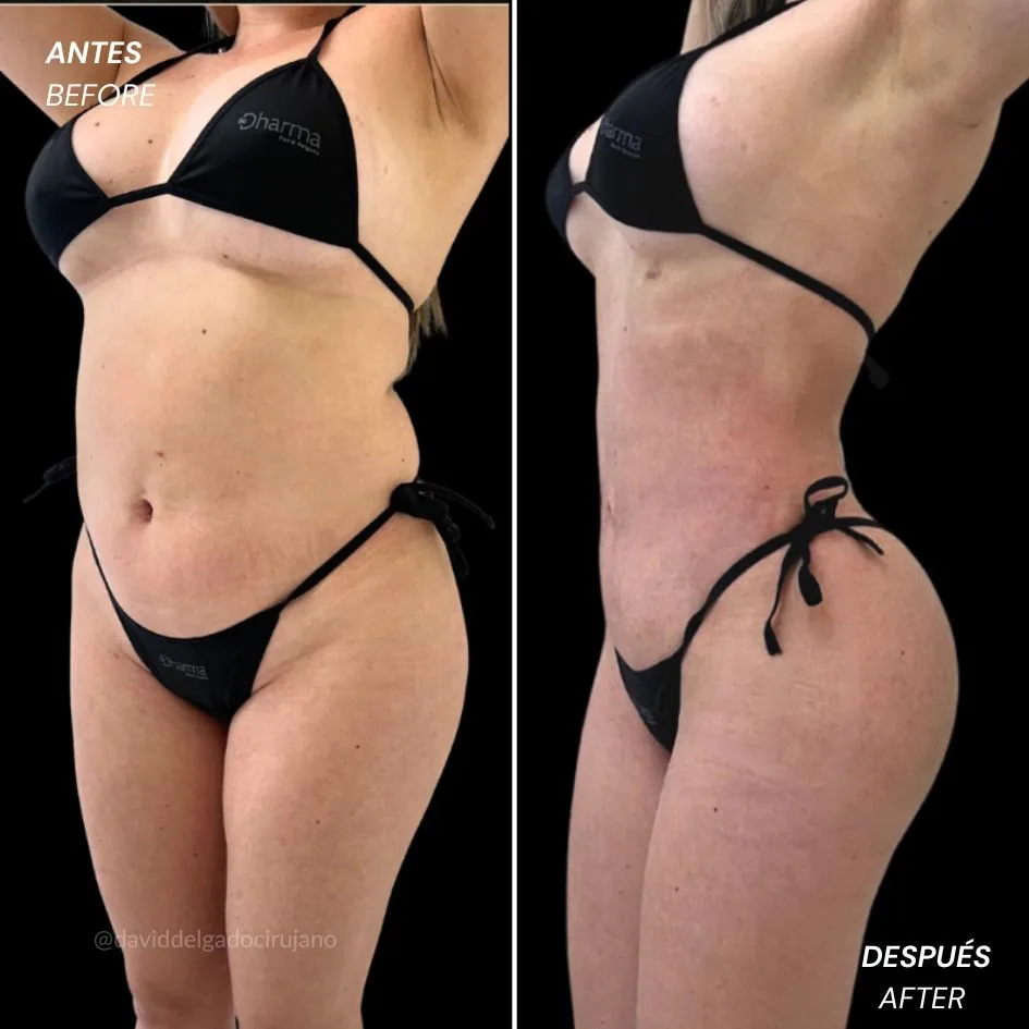 Female liposculpture before and after, waist and body definition result by Dr. David Delgado in Colombia