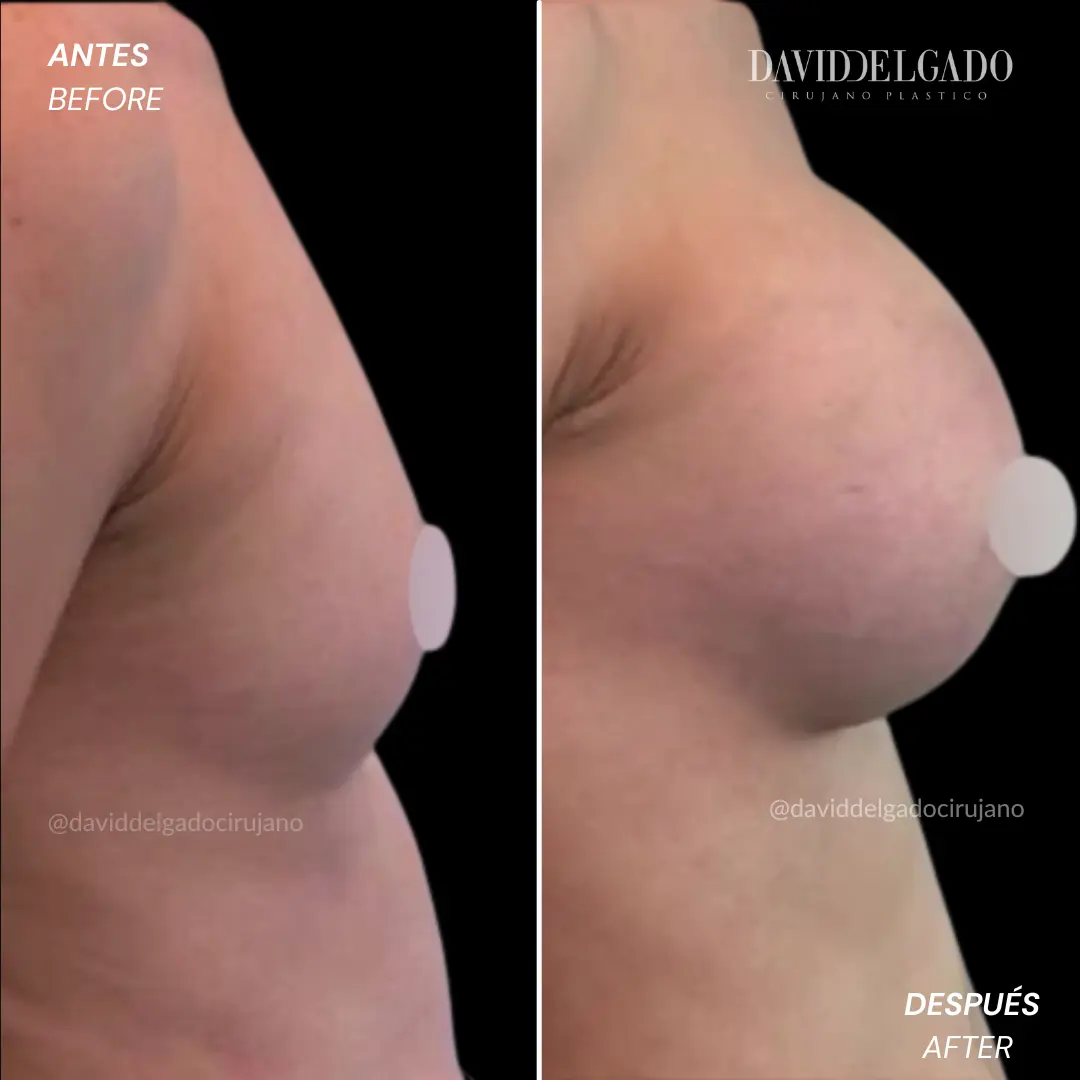 Breast augmentation before and after results in Colombia