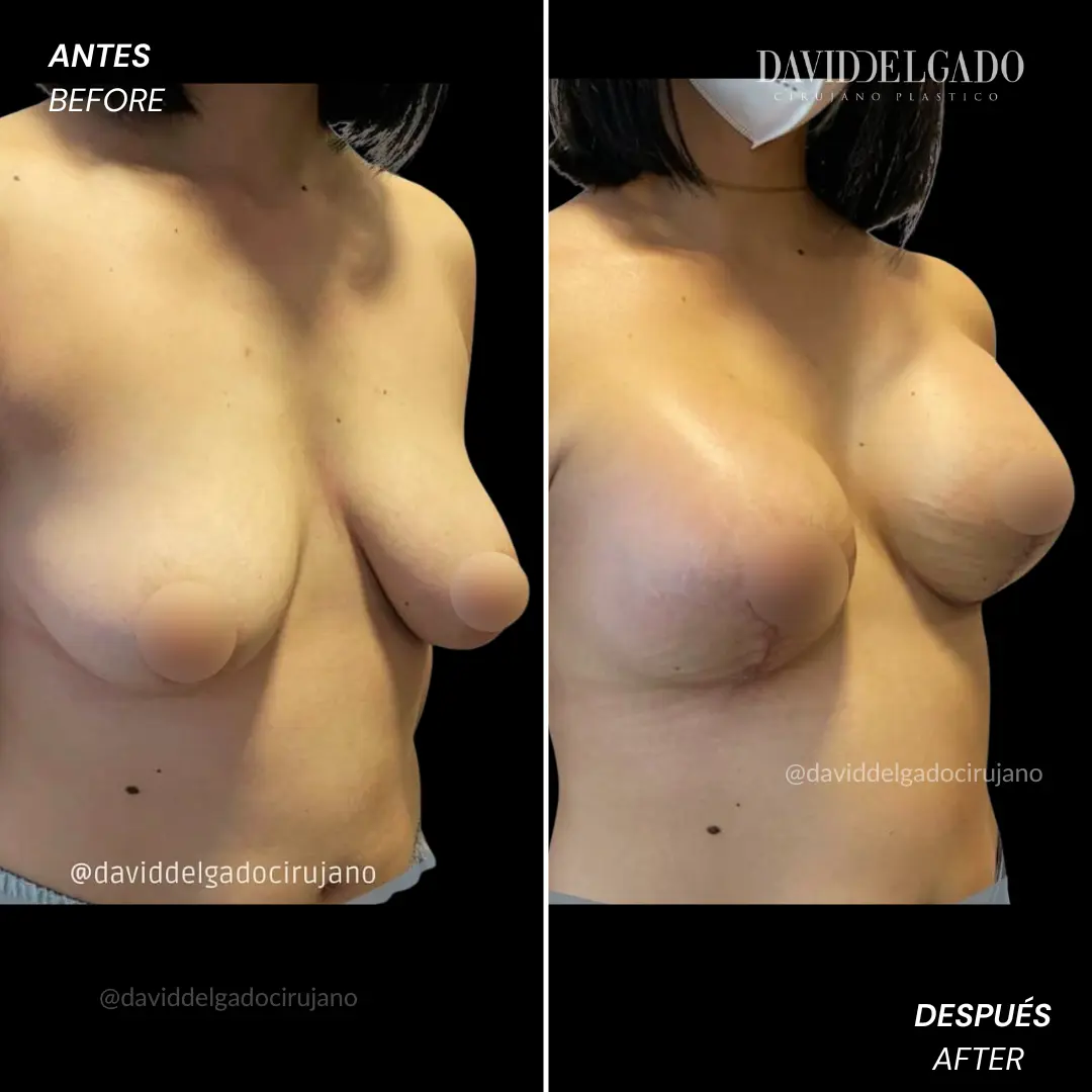Breast augmentation transformation with Dr. David Delgado