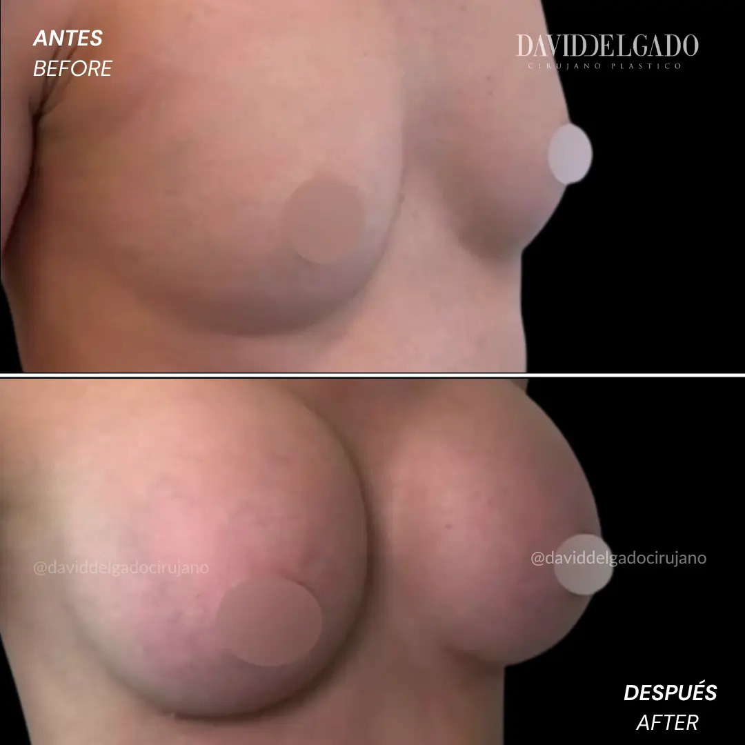 Breast implants before and after in Medellín with Dr. David Delgado