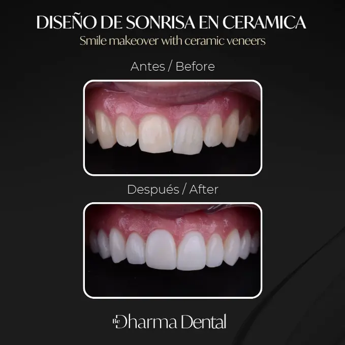 Dental Tourism Colombia- Plastic Surgery Medellín- Before and After Colombia