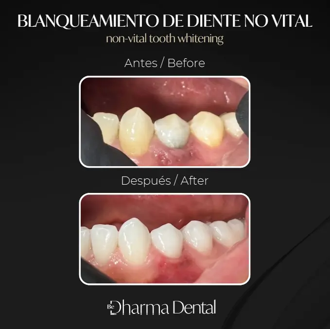 Dental Tourism Colombia- Plastic Surgery Medellín- Before and After